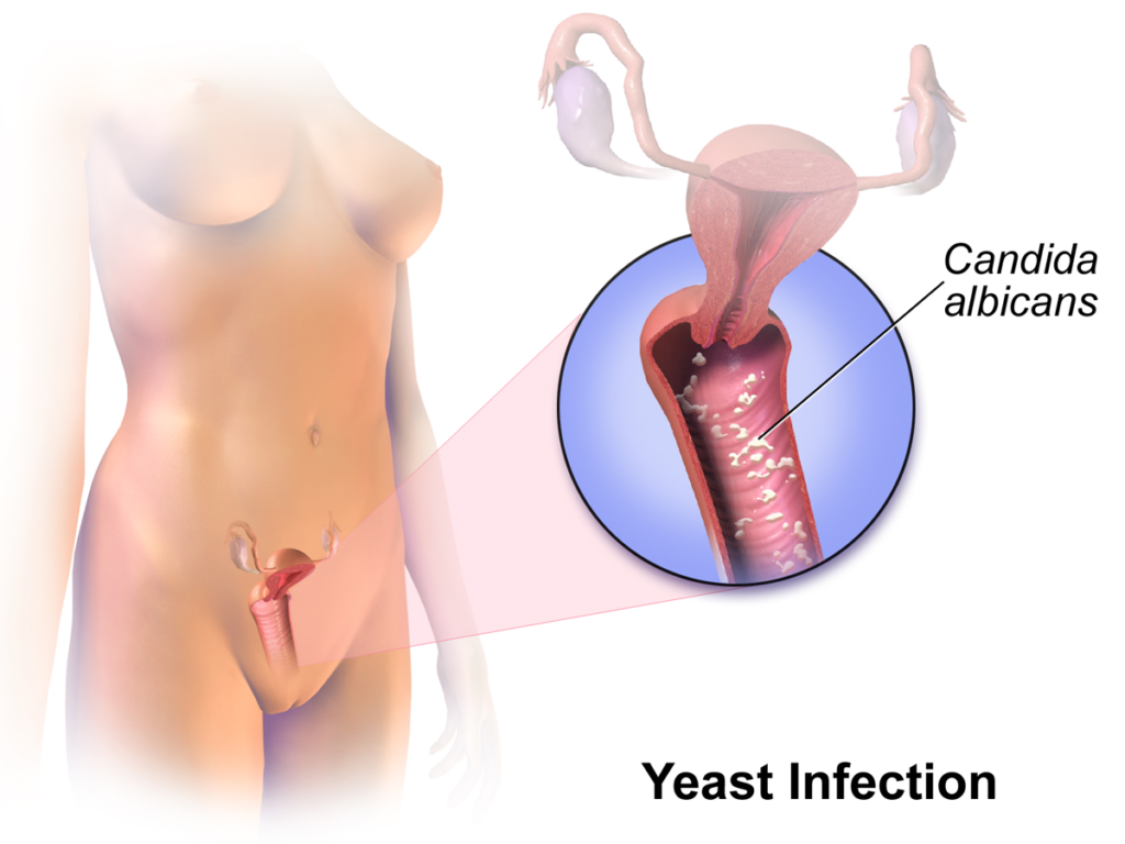 Candida Infection / Vaginal Yeast