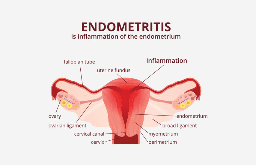 Endometrium & Endometritis